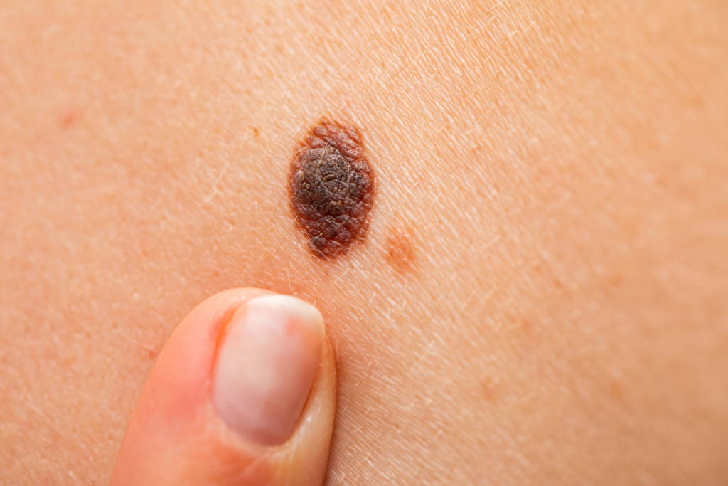 Australian Researchers Find 45 New Genetic Causes Of Non melanoma Skin 